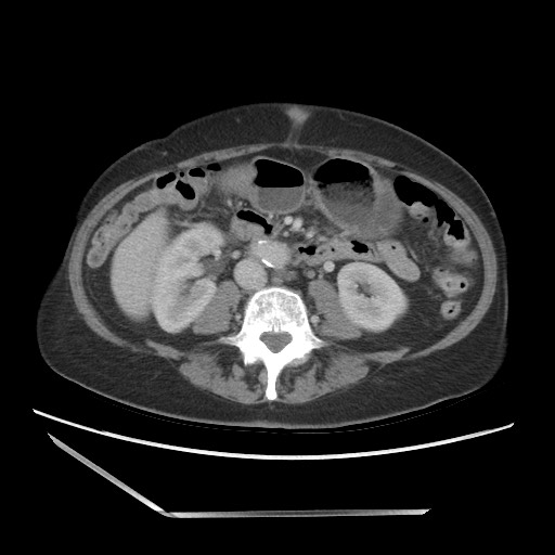 Bilateral adrenal granulocytic sarcomas (chloromas) (Radiopaedia 78375-91007 A 63).jpg