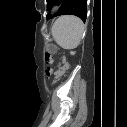 Bilateral adrenal granulocytic sarcomas (chloromas) (Radiopaedia 78375-91007 C 111).jpg