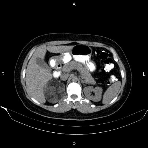 File:Bilateral adrenal myelolipoma (Radiopaedia 63058-71535 Axial non-contrast 51).jpg