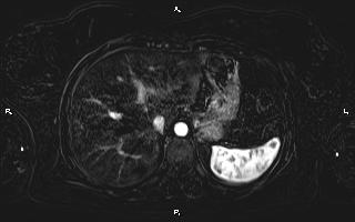 Bilateral adrenal myelolipoma (Radiopaedia 63058-71537 I 23).jpg