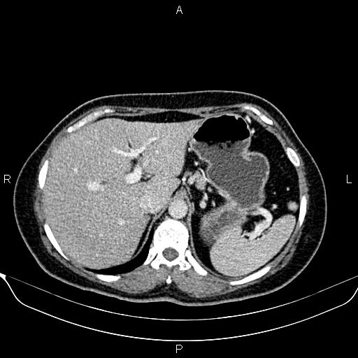 Bilateral benign adrenal adenomas (Radiopaedia 86912-103124 B 27).jpg