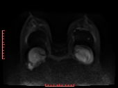 File:Bilateral breast implant rupture (Radiopaedia 24761-25027 DWI 19).jpg