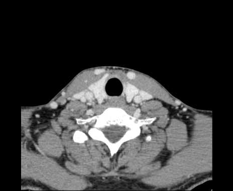 File:Bilateral carotid body tumors (Radiopaedia 61841-69870 Axial Post contrast 89).jpg