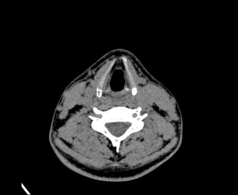Bilateral carotid body tumors (Radiopaedia 61841-69870 Axial non-contrast 68).jpg