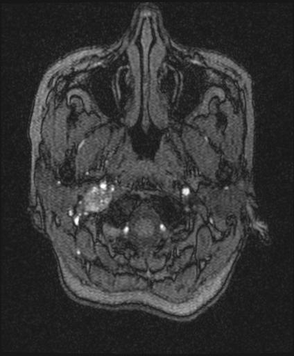 Bilateral carotid body tumors and right glomus jugulare tumor (Radiopaedia 20024-20060 Axial MRA 11).jpg
