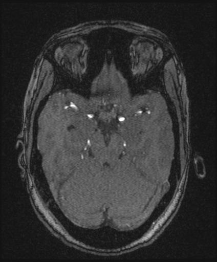 Bilateral carotid body tumors and right glomus jugulare tumor (Radiopaedia 20024-20060 Axial MRA 68).jpg