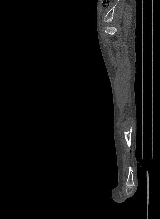 Bilateral fibular hemimelia type II (Radiopaedia 69581-79491 Sagittal bone window 29).jpg