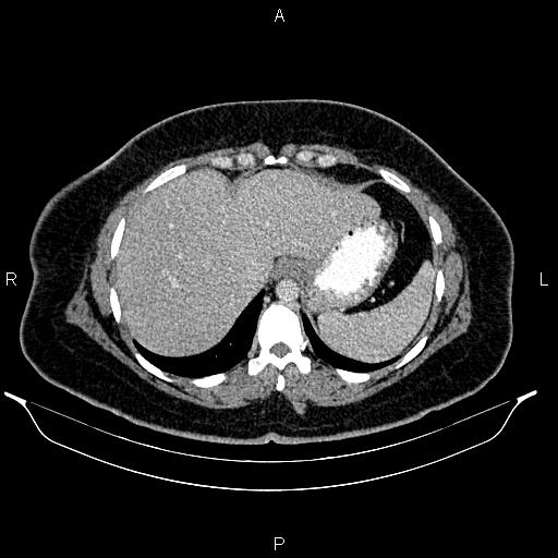 Bilateral ovarian dermoid cysts (Radiopaedia 85785-101603 A 19).jpg