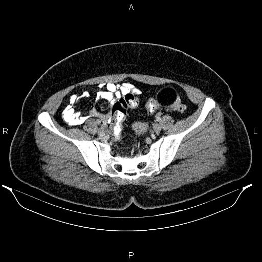 File:Bilateral ovarian dermoid cysts (Radiopaedia 85785-101603 A 84).jpg
