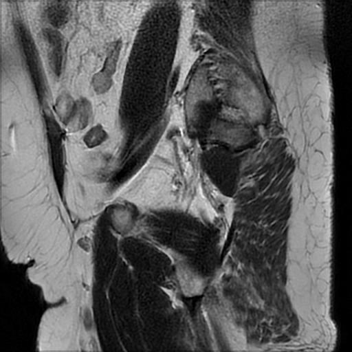 File:Bilateral ovarian dermoid cysts (Radiopaedia 90152-107338 Sagittal T2 21).jpg