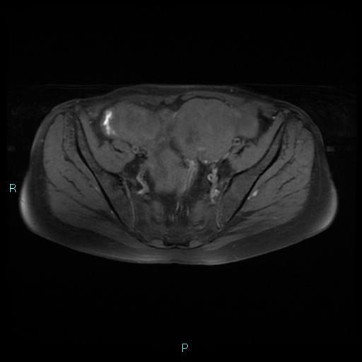 File:Bilateral ovarian fibroma (Radiopaedia 44568-48293 Axial T1 fat sat 10).jpg
