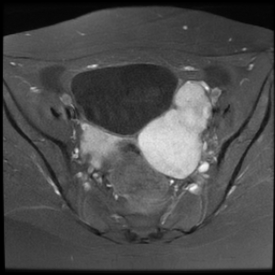 File:Bilateral ovarian fibrothecomas - adolescent (Radiopaedia 86604-102707 Axial T1 C+ fat sat 14).jpg