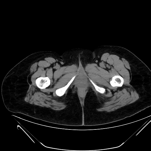 File:Bilateral ovarian mature cystic teratomas (Radiopaedia 79373-92457 Axial non-contrast 104).jpg