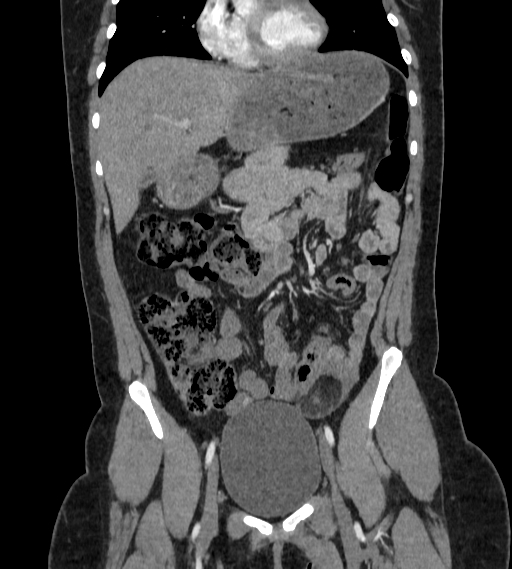 File:Bilateral ovarian mature cystic teratomas (Radiopaedia 79373-92457 B 19).jpg