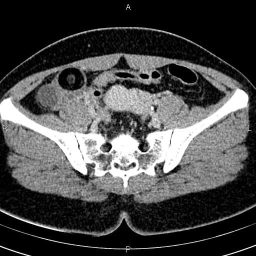 File:Bilateral ovarian teratoma (Radiopaedia 83131-97503 B 27).jpg