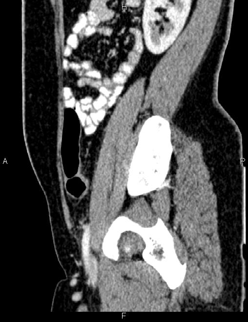 Bilateral ovarian teratoma (Radiopaedia 83131-97503 D 82).jpg