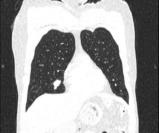 Bilateral pulmonary AVM (Radiopaedia 83134-97505 Coronal lung window 26).jpg
