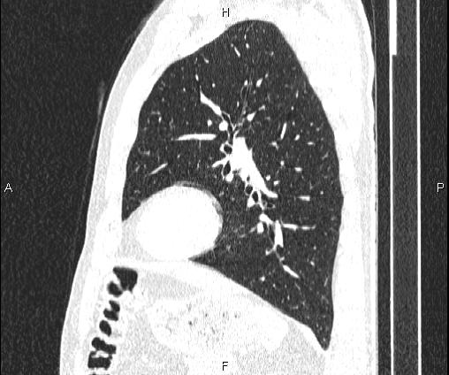 Bilateral pulmonary AVM (Radiopaedia 83134-97505 Sagittal lung window 79).jpg