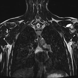 File:Bilateral spinoglenoid notch ganglion cysts (Radiopaedia 29577-30082 Coronal T2 80).jpg