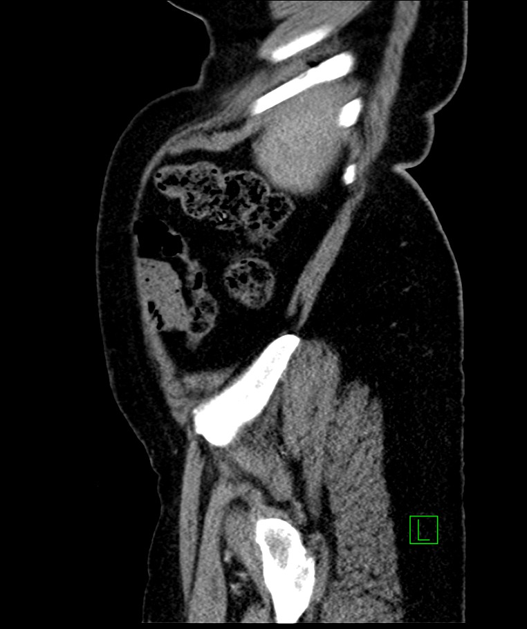 Bilateral sporadic synchronous clear cell renal cell carcinoma (Radiopaedia 85035-100575 E 23).jpg