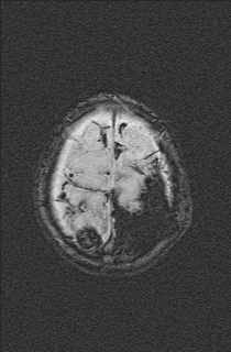 File:Bilateral subdural hemorrhage and parietal skull fracture (Radiopaedia 26058-26190 Axial SWI 74).png