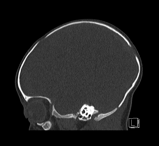 Bilateral subdural hemorrhage and parietal skull fracture (Radiopaedia 26058-26192 Sagittal bone window 29).png