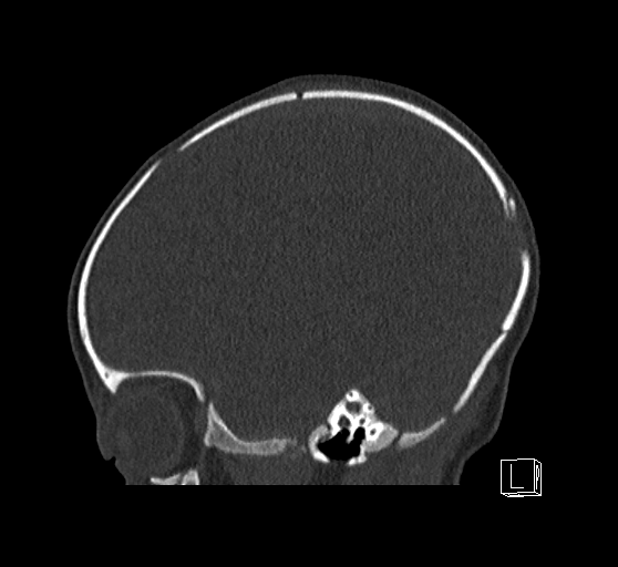 File:Bilateral subdural hemorrhage and parietal skull fracture (Radiopaedia 26058-26192 Sagittal bone window 71).png