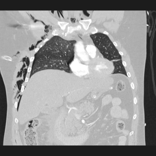 Bilateral traumatic renovascular injury (Radiopaedia 32051-32995 Coronal lung window 30).jpg