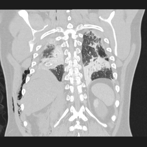 Bilateral traumatic renovascular injury (Radiopaedia 32051-32995 Coronal lung window 63).jpg