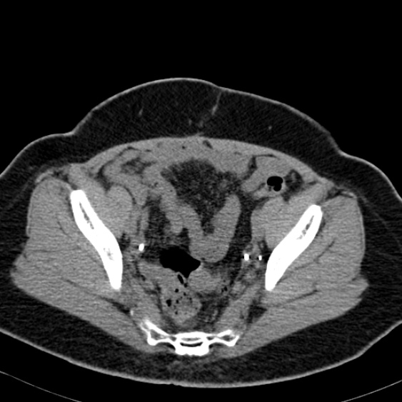 Bilateral ureteric stents (Radiopaedia 48795-53825 Axial non-contrast 54).jpg