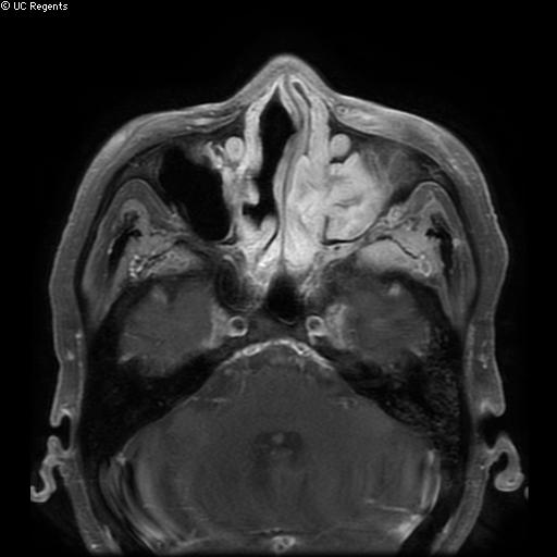 Bisphosphonate-related osteonecrosis of the maxilla (Radiopaedia 51367-57101 Axial T1 C+ fat sat 30).jpg