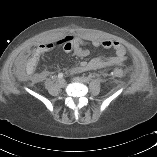 Bladder rupture post renal biopsy (Radiopaedia 30863-31572 Axial non-contrast 56).jpg