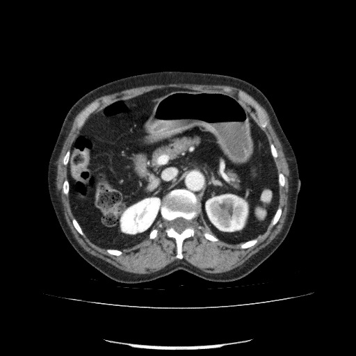 File:Bladder tumor detected on trauma CT (Radiopaedia 51809-57609 B 45).jpg