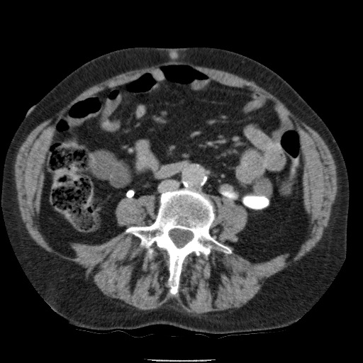 Bladder tumor detected on trauma CT (Radiopaedia 51809-57609 C 79).jpg