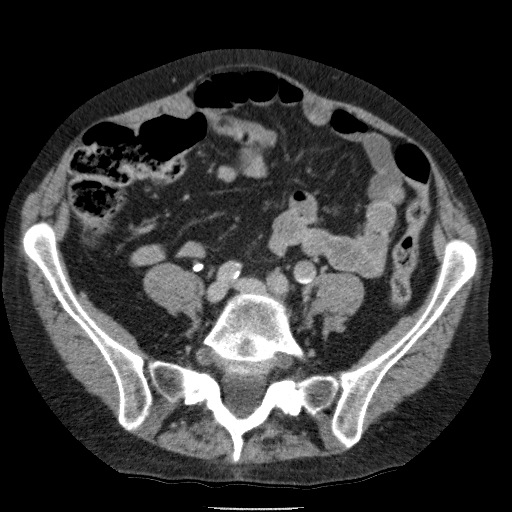 Bladder tumor detected on trauma CT (Radiopaedia 51809-57609 C 92).jpg