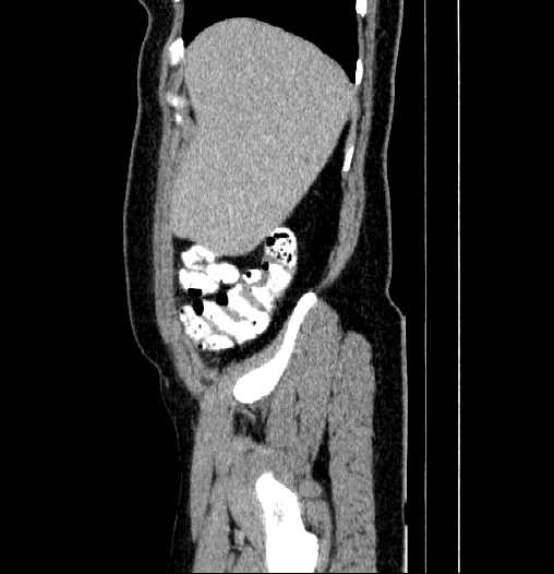 Blind-ending branch of a bifid ureter (Radiopaedia 61159-69048 E 6).jpg