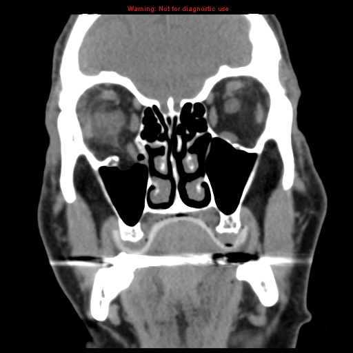 File:Blowout fracture with inferior rectus entrapment (Radiopaedia 12418-12673 Coronal non-contrast 11).jpg