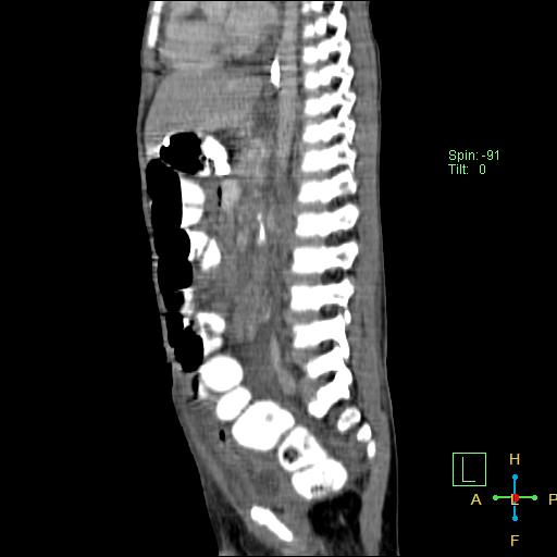 File:Blunt abdominal trauma (Radiopaedia 24780-25044 D 15).jpg