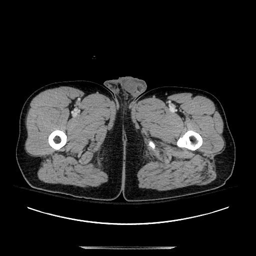 Blunt abdominal trauma with solid organ and musculoskelatal injury with active extravasation (Radiopaedia 68364-77895 A 180).jpg