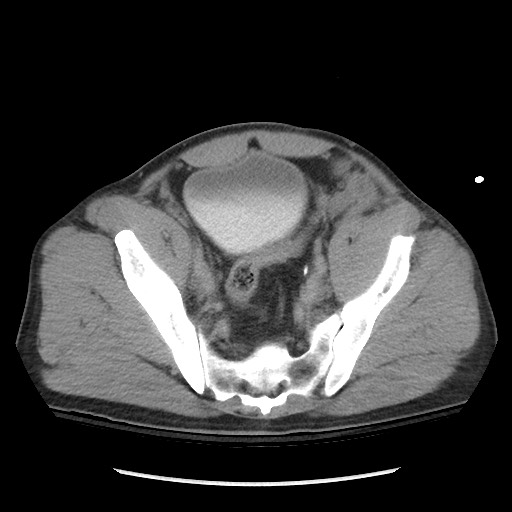 Blunt abdominal trauma with solid organ and musculoskelatal injury with active extravasation (Radiopaedia 68364-77895 Axial C+ delayed 114).jpg