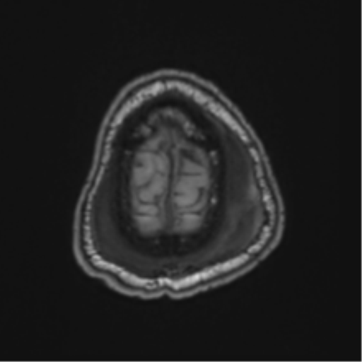 File:Blunt cerebrovascular injury (Radiopaedia 53682-59745 Axial T1 29).png