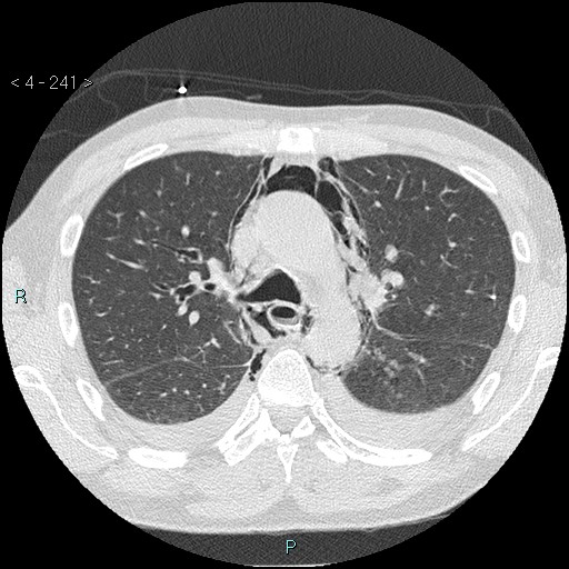 Boerhaave syndrome (Radiopaedia 27683-27897 lung window 4).jpg