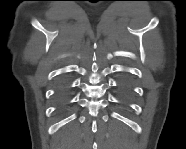 Boerhaave syndrome (Radiopaedia 39382-41660 C 81).png