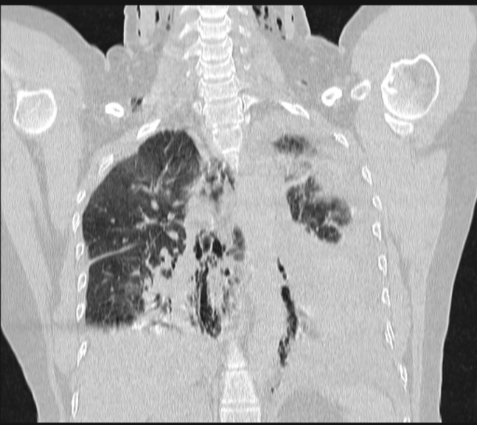 Boerhaave syndrome (Radiopaedia 45644-49799 Coronal lung window 45).jpg