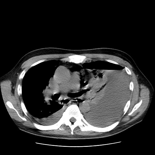 Boerhaave syndrome (Radiopaedia 59796-67310 Axial liver window 29).jpg