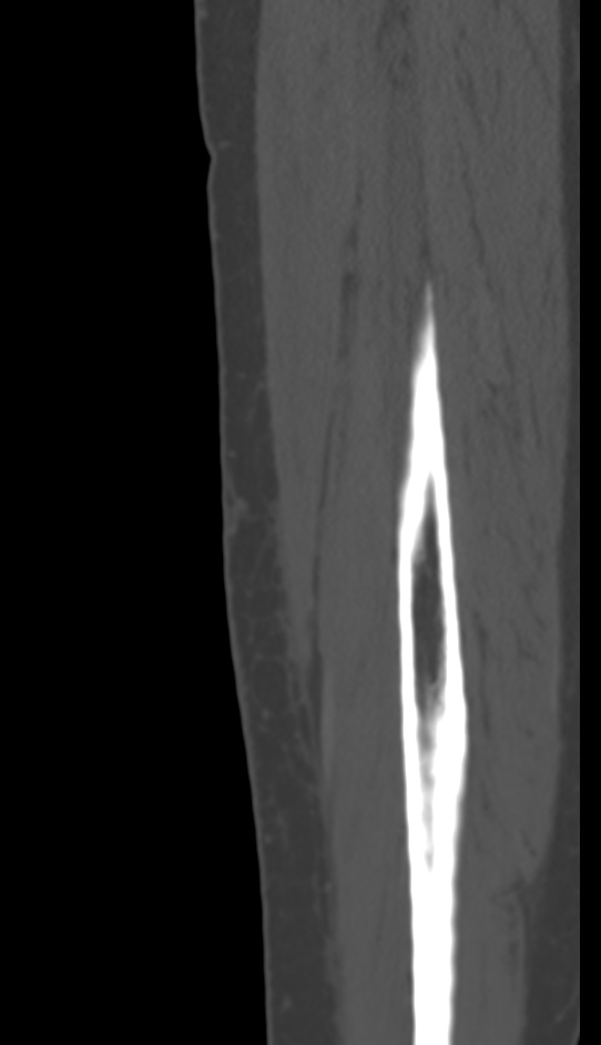 Bone metastasis - tibia (Radiopaedia 57665-64609 Sagittal bone window 162).jpg