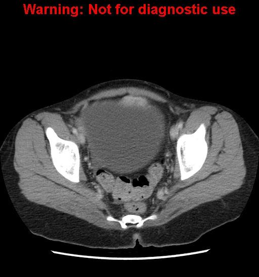Borderline mucinous cystadenoma of ovary (Radiopaedia 25586-25767 A 101).jpg