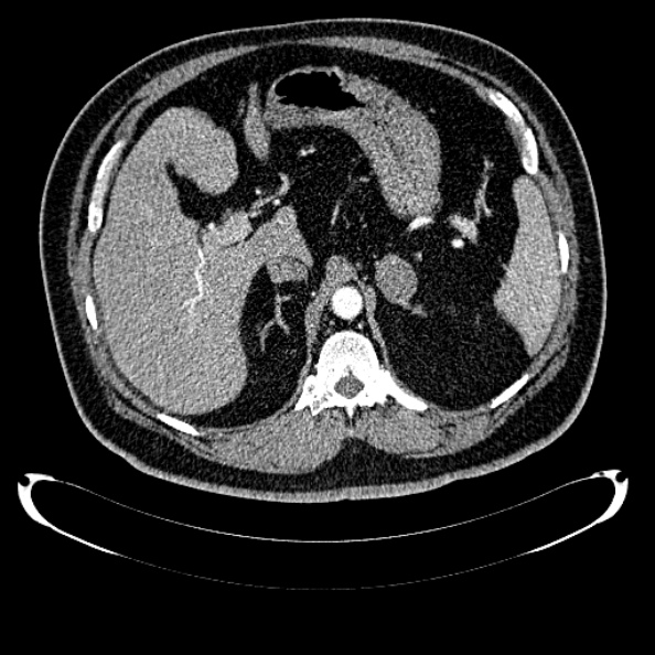 Bosniak renal cyst - type IV (Radiopaedia 24244-24518 B 80).jpg