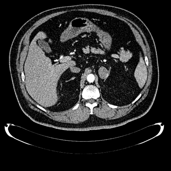 Bosniak renal cyst - type IV (Radiopaedia 24244-24518 B 89).jpg
