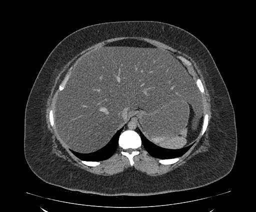 File:Bowel and splenic infarcts in acute lymphocytic leukemia (Radiopaedia 61055-68913 A 32).jpg